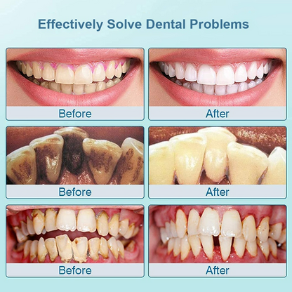 Sonic Smile™ - Ultrasonic Plaque Remover